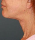 Feel Beautiful - Sagging Neck Lift - After Photo